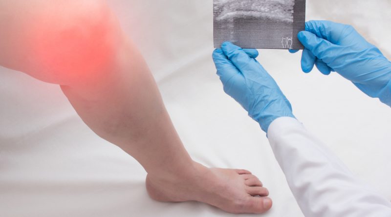 Knee Bursitis Treatment