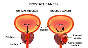 global prostate cancer market